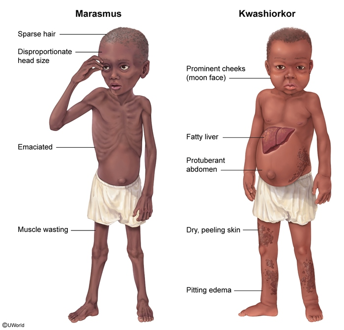 <p>(1) Edema</p><p>(2) to waste away</p><p>(3) Mild to moderate</p><p>(4) gradually</p><p>(5) Severe</p><p>(6) Rapid </p><p>(7) muscle; body fat</p><p>(8) Fatty liver</p><p>(9) Skin; bones</p><p>(10) Listlessness; hair; skin</p>