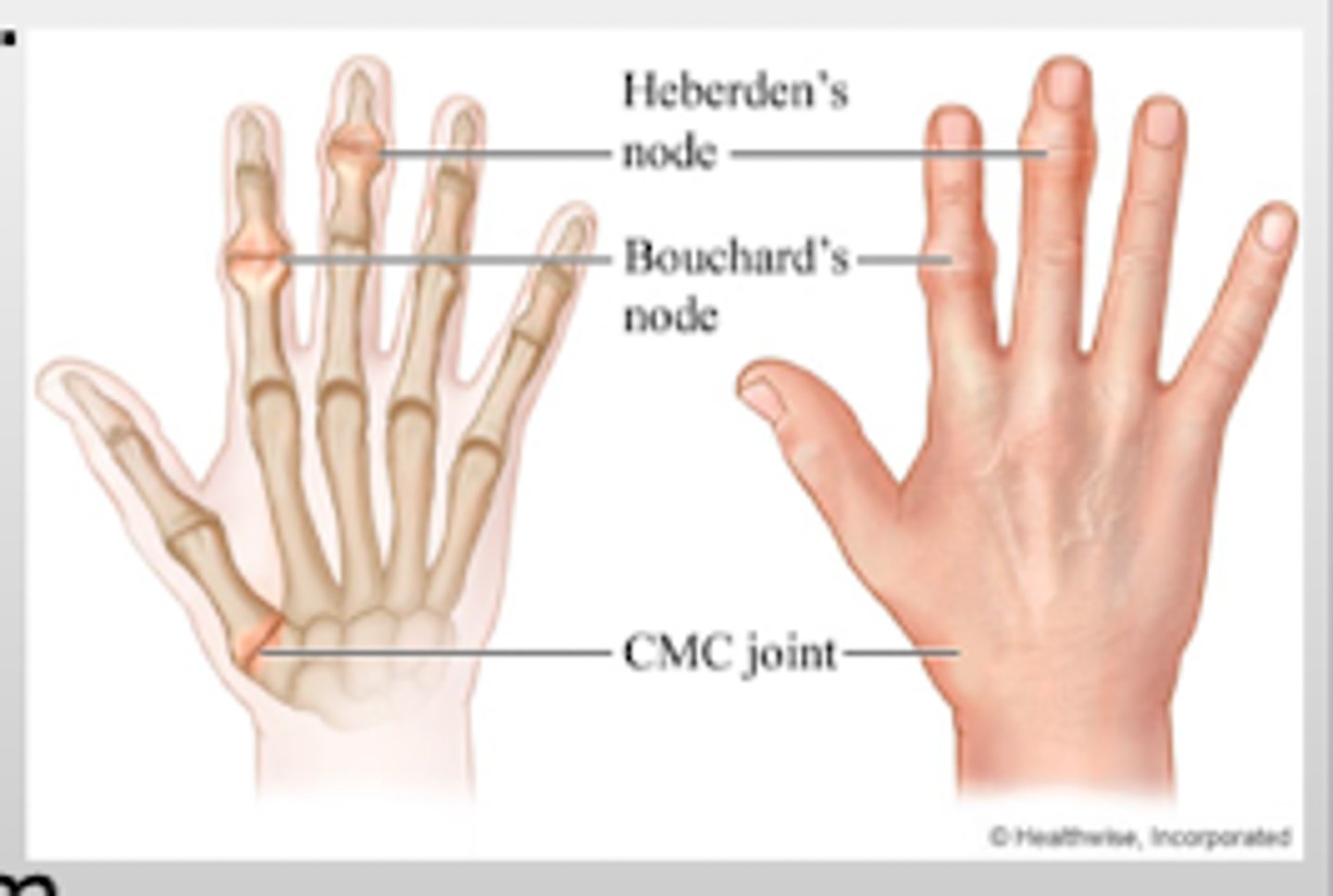 <p>DIP joints (OA)</p>