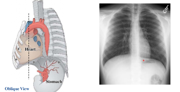 <p>-inferior limit of heart is diaphragm- fused</p><p>-heart descends with diaphragm at each inspiration</p><p>-diaphragmatic surface of heart is not in a transverse plane, so they look like they overlap in an x-ray</p><p>-hemidiaphragms: individual halves of the diaphragm</p>