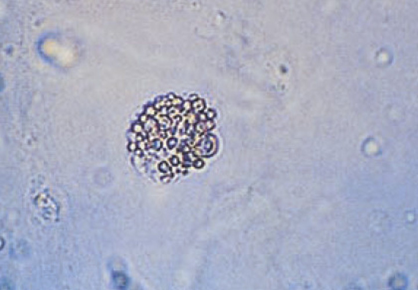 <p>- RTE cells with fat globules inside them</p>