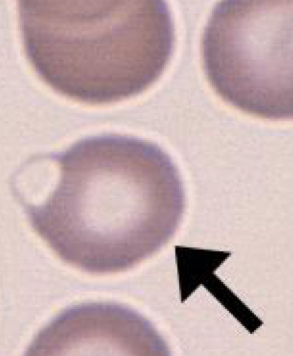 Name this RBC Abnormality.