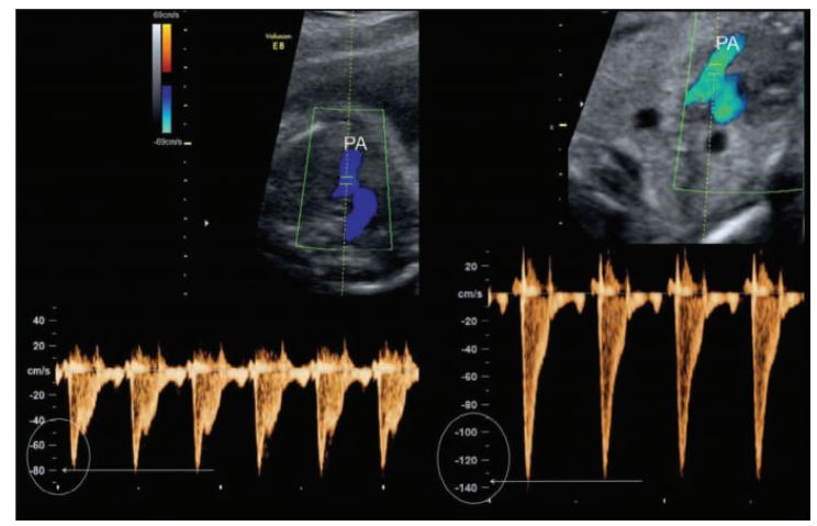 <p>Pulmonic flow patterns are obtained parallel to flow in the high short-axis plane with the Doppler cursor at the level of the pulmonic cusps. The cursor is moved into the main pulmonary artery to map any changes in the flow pattern.</p><p> The mean velocity in the pulmonary artery ranges from 60 to 80cm/sec. Note the high-velocity pulmonic flow on the right which could be from. ________PA, Pulmonary artery.</p>