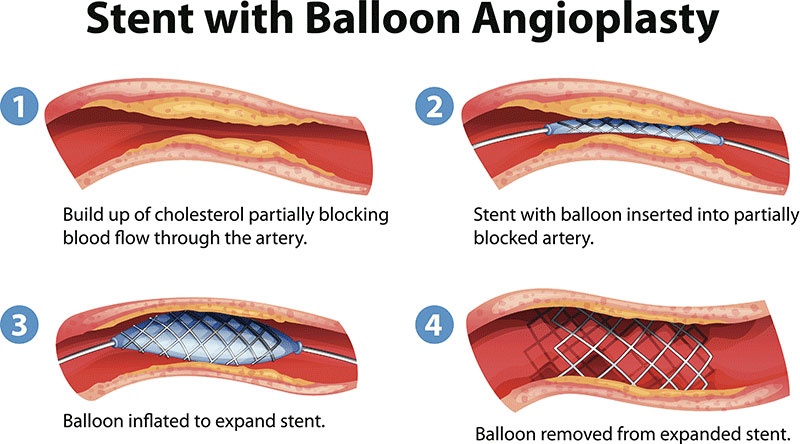 <p>-procedure to treat atherosclerosis</p><p>-balloon goes into artery and inflates, then a stent is placed in the artery to keep it expanded</p><p>-patient goes home w/in a few hrs</p>