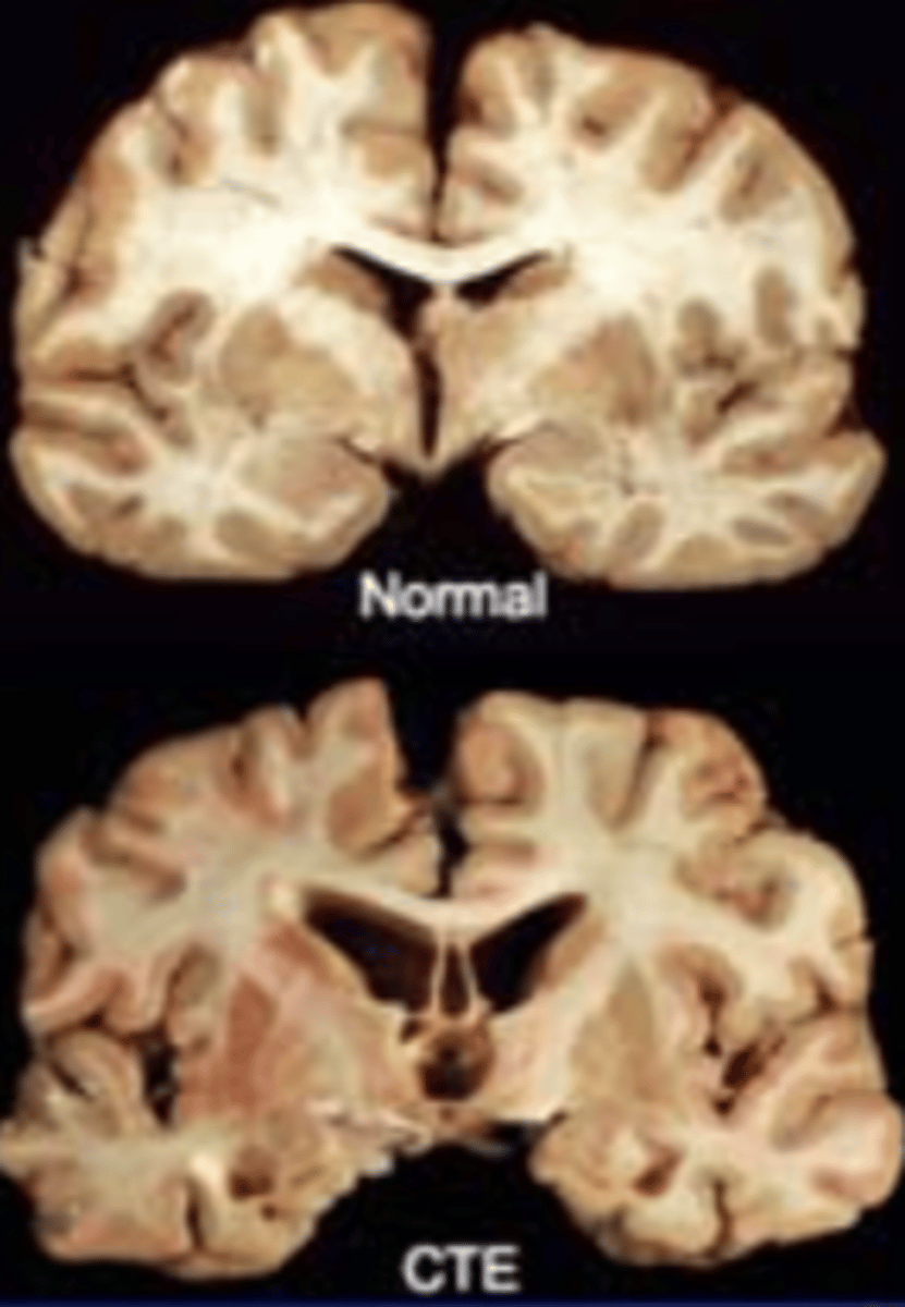 <p>· Chronic Traumatic Encephalopathy- Multiple mild traumatic brain injuries (mTBI = concussions)</p><p>o "A progressive neuro-degenerative disease of the brain found in athletes (&amp; others) with a history of repetitive brain trauma, including symptomatic concussions as well as asymptomatic sub-concussive hits to the head."</p><p>· First reported and cited in Boxers in late 1920's</p><p>o "Punch Drunk Syndrome"</p>