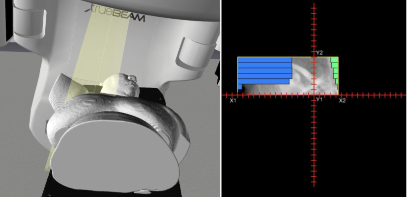 <p>Describe this treatment technique</p>