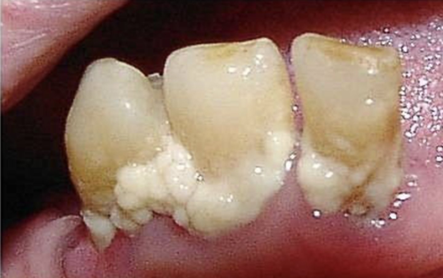 <p>A soft &amp; white cottage-cheese resembling deposit, it is easily removable.</p>