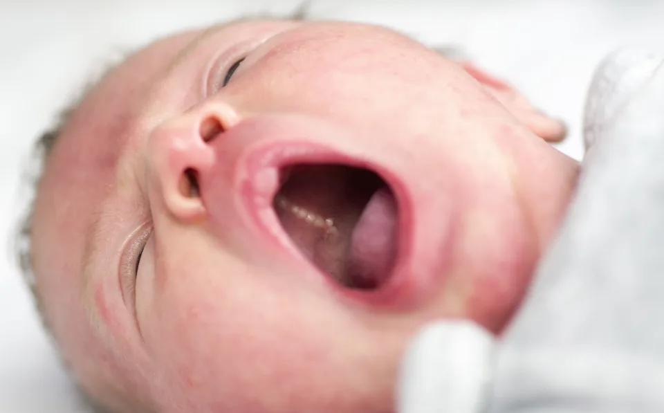 <p>Wit-gele cysten op het verhemelte rond middellijn </p>