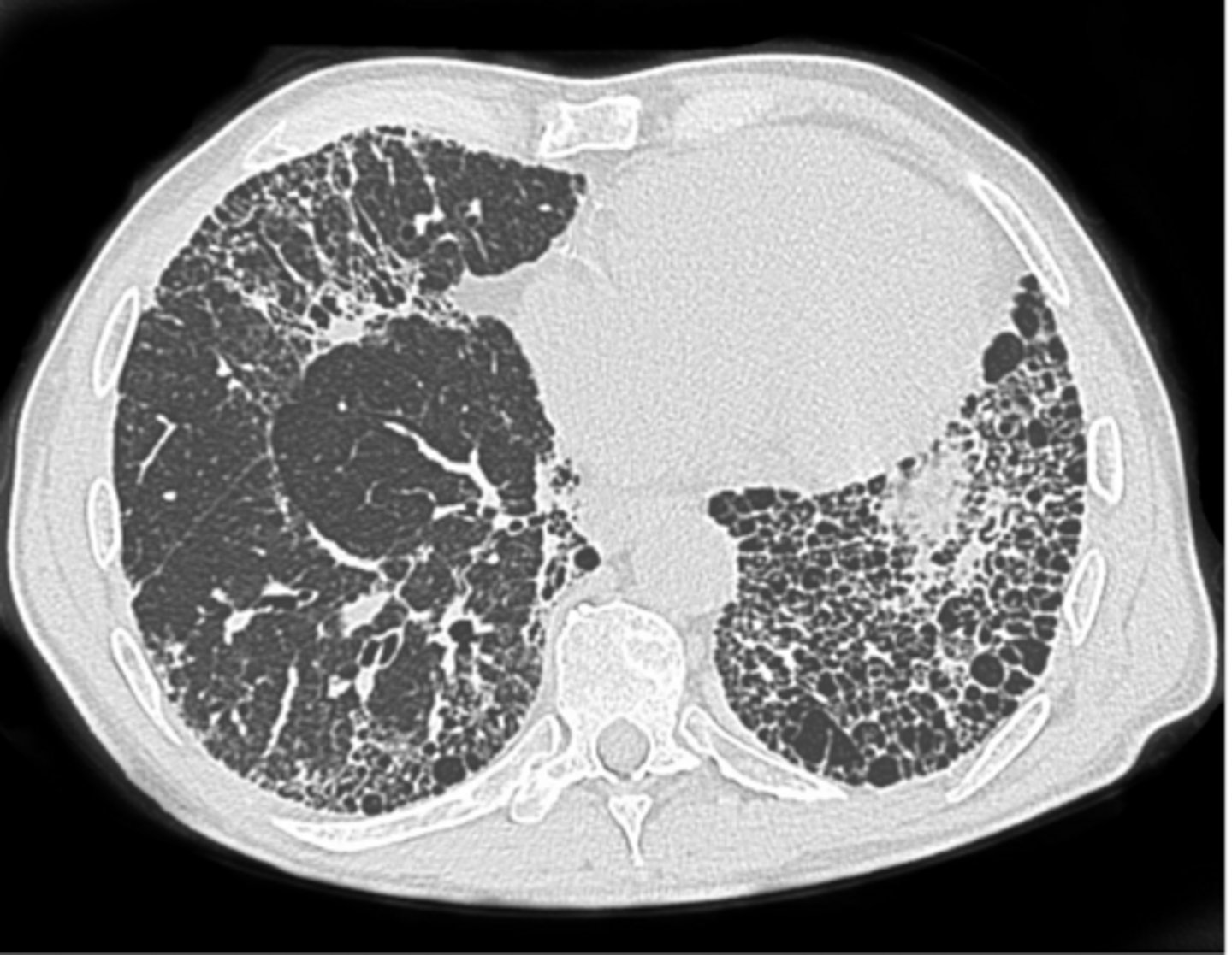 <p>What is this pattern of interstitial lung disease?</p>