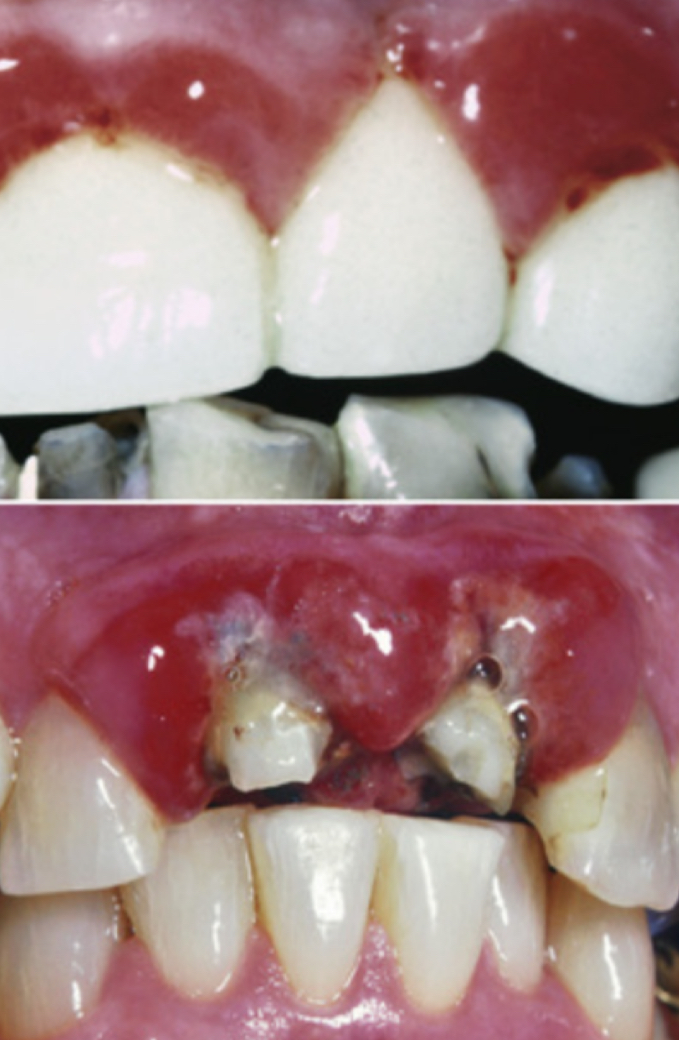 <p>High noble- 60%- 40% of which is gold- not recommended for FDP</p><p>Noble- 25%, palladium based</p><p>Predominantly base metal- less than 25%, commonly use nickel-chromium, if allergic cobalt-chromium, high elastic modulus than noble </p>