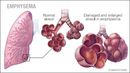 Shortness of breath and cough are the main symptoms of emphysema. As the disease progresses, other symptoms include:

-Fatigue
-Weezing
-Chest tightness
-Anxiety