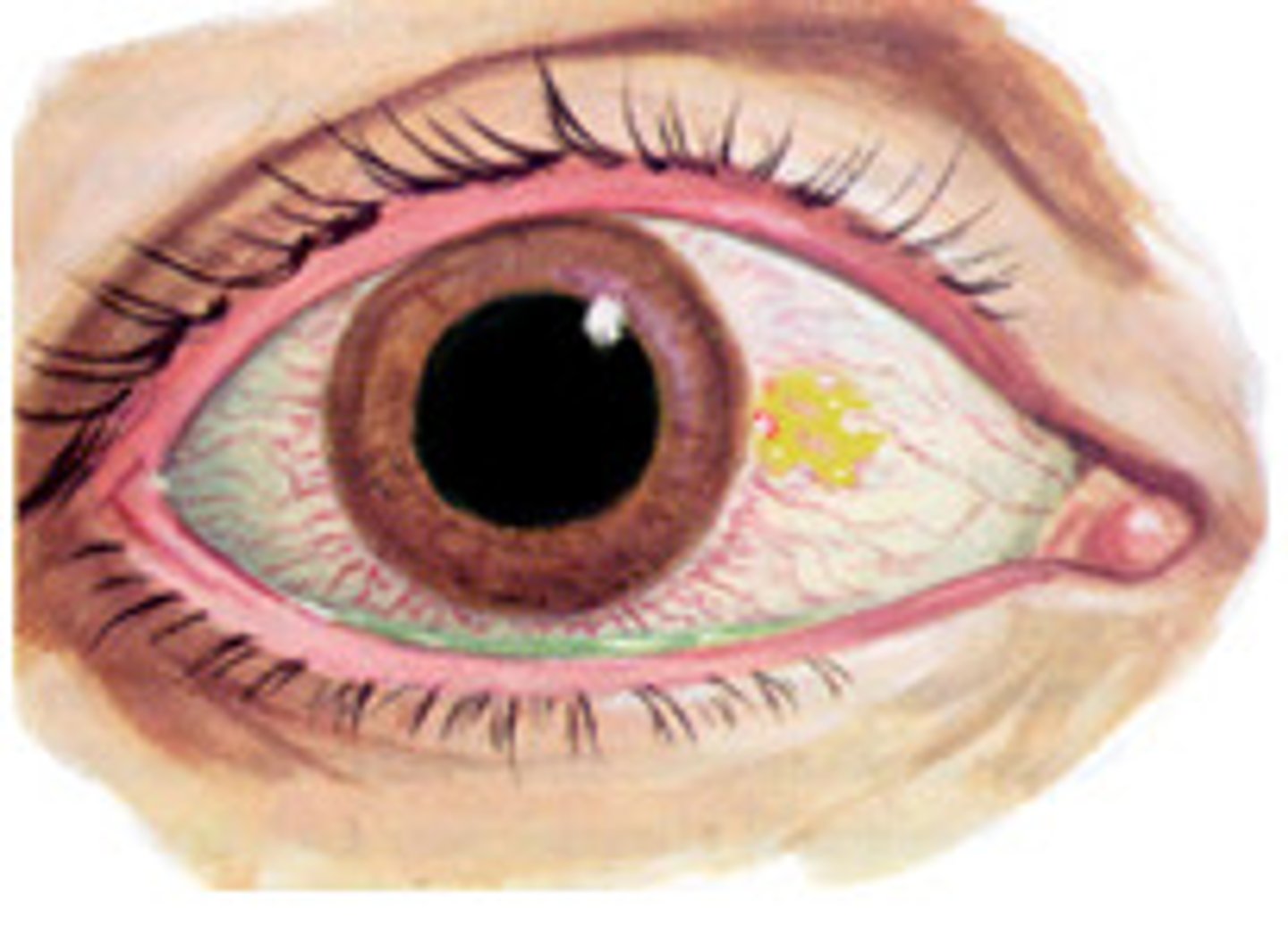 <p>where iris meets sclera</p>