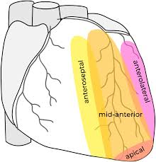 <p><strong>Anteroapical infarction</strong>, likely due to occlusion of the<strong> distal LAD</strong>, affecting the<strong> apex of the heart.</strong></p>