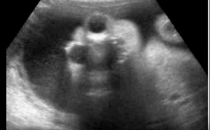 <p>a) no cavum septum pellucidum</p><p>b) acrania</p><p>c) encephalocele</p><p>d) anencephaly</p>