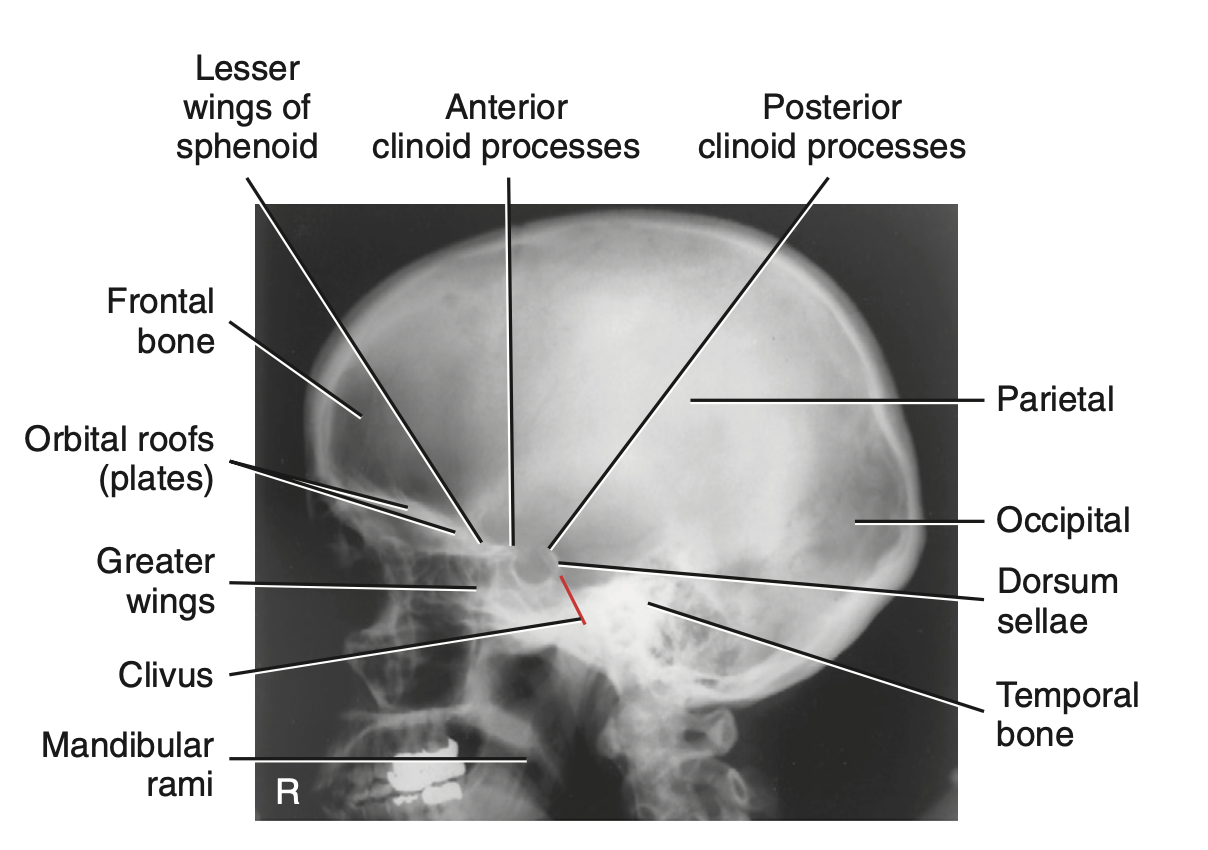 <p>What is <u>best demonstrated</u> for <strong>RT and LT lateral </strong>method for <strong>skull</strong>?</p>