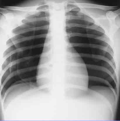 <p>What is this x-ray demonstrating?</p>