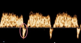 <p>This is a doppler waveform of the ductus venosus. </p><ol><li><p>Does it look normal or abnormal?</p></li><li><p>If abnormal, what about it is?</p></li></ol><p></p>