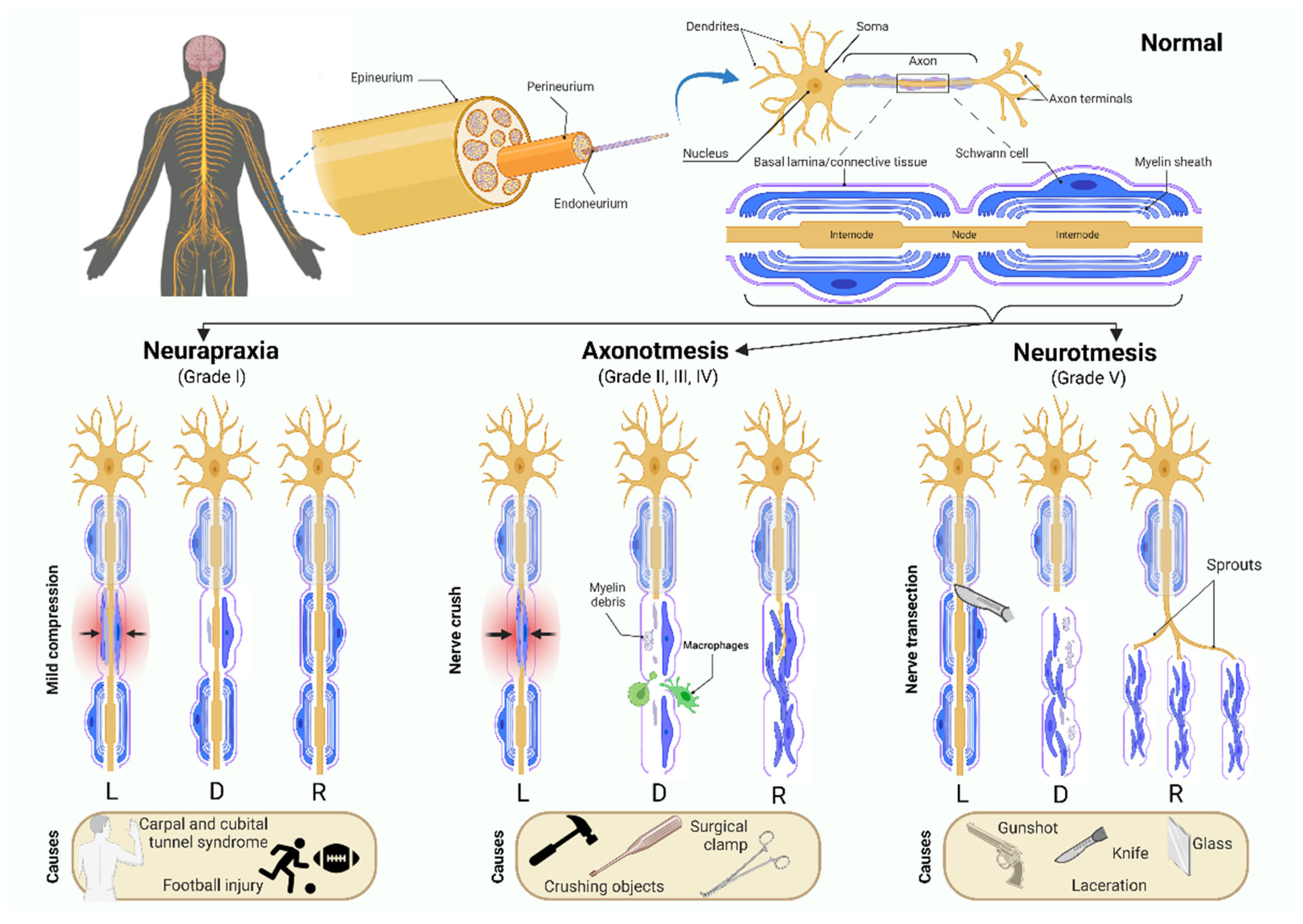 <p>-a more severe grade of injury to a peripheral nerve. is reversible injury to damaged fibers. <br />
-nerve can regenerate distal to the site of lesion by one millimeter per day.<br />
-loss of sensation means the pt will likely not be aware of injury, so important to address with visual compensation</p>