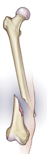 <p>a break in the bone where the broken ends protrude through the skin and are misaligned. </p>