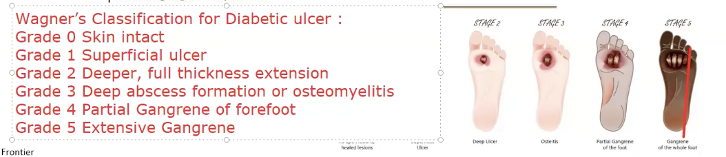 <ul><li><p>diabetic / neuropathic ulcer</p><ul><li><p>usually seen over the sole of the foot (weight-bearing surface)</p></li></ul></li><li><p>Wagner scale</p><ul><li><p>grade 0, 1, 2, 3, 4, 5 </p></li></ul></li></ul><p></p>