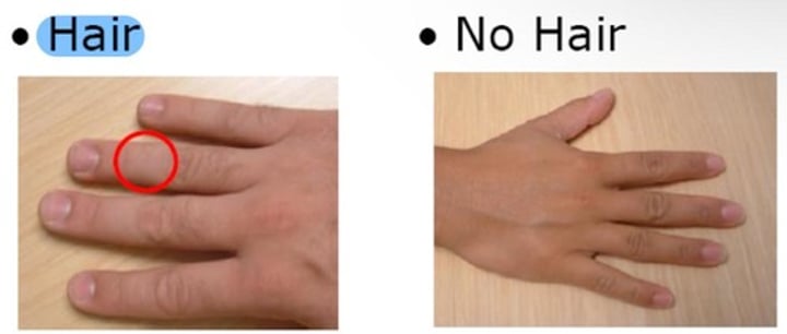 <p><strong>Hair</strong></p><p><span class="bgP">- dominant</span></p><p>- the presence of hair on the middle segment of any finger</p><p></p><p><strong>No hair</strong></p><p><span class="bgP">- recessive</span></p>