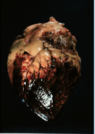 <p>epicardial & endocardial tissue</p>
