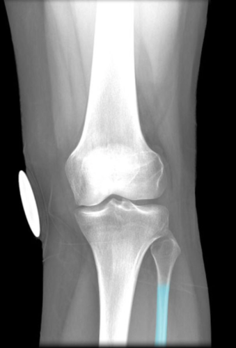 Comment:
Attached to shaft of tibia by
interosseous membrane of leg