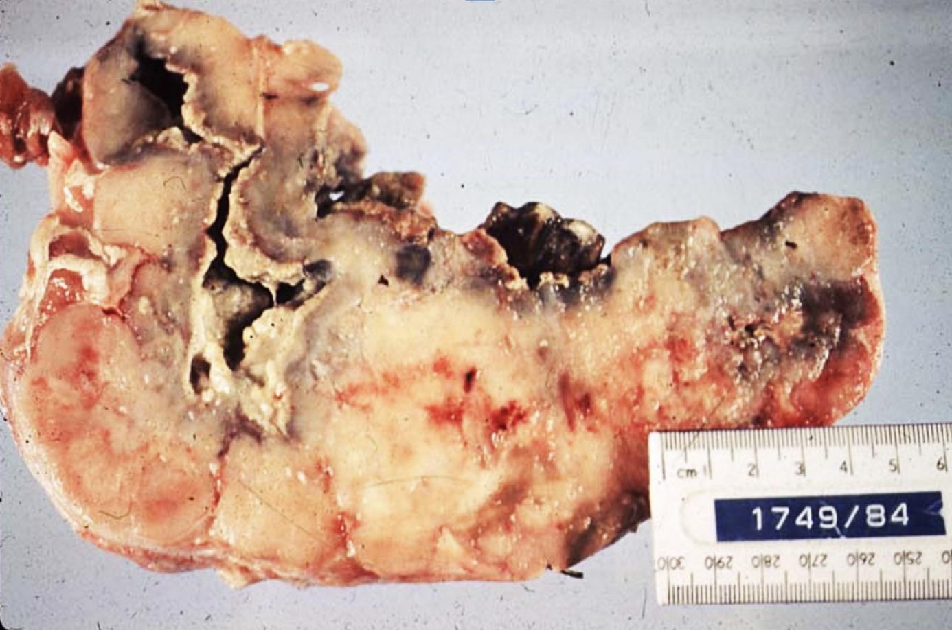 <p><span style="background-color: transparent;">This was taken from a deer. </span></p><p><span style="background-color: transparent;">The lesion is slow growing with purulent exudate draining, caused by mandibular osteomyelitis (“Lumpy jaw”).  What is the distribution of this lesion?</span></p>