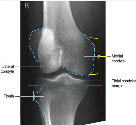 <p>good lat 45 OBL</p><ul><li><p>MAIN: fib aligned with ant.edge of tib</p></li><li><p>SUPPORTING:</p><ul><li><p>½ patella free of SI</p></li><li><p>med.con in profile with no SI of lat.con</p></li></ul></li></ul><p></p>
