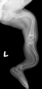 <p>disease progresses with few to many hundreds of fractures over lifetime → as it heals the large disproportionate callus leaves a deformity </p>
