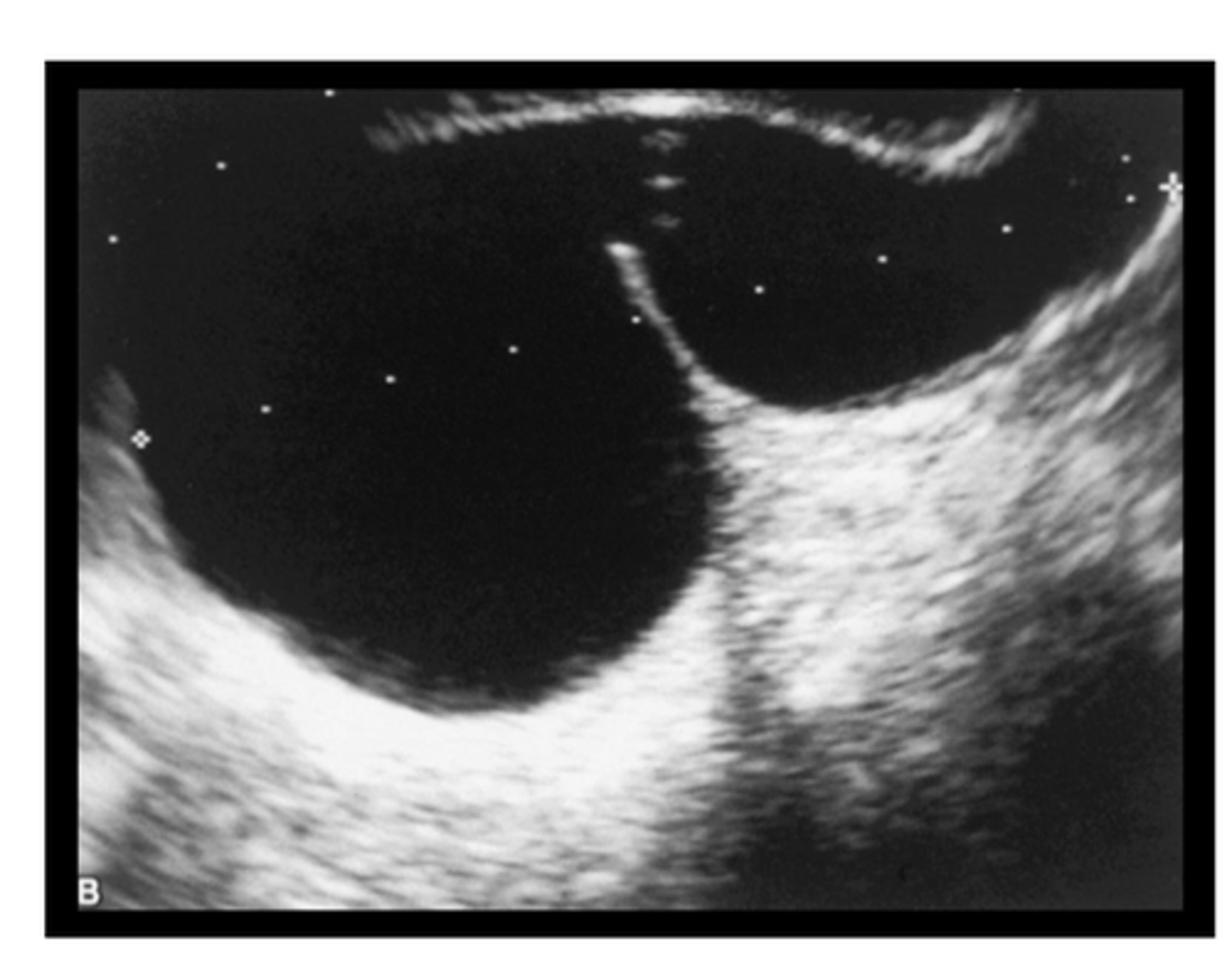 <p>Anechoic tubular adnexal structure, can be chronic conditionafter recovery from PID</p>