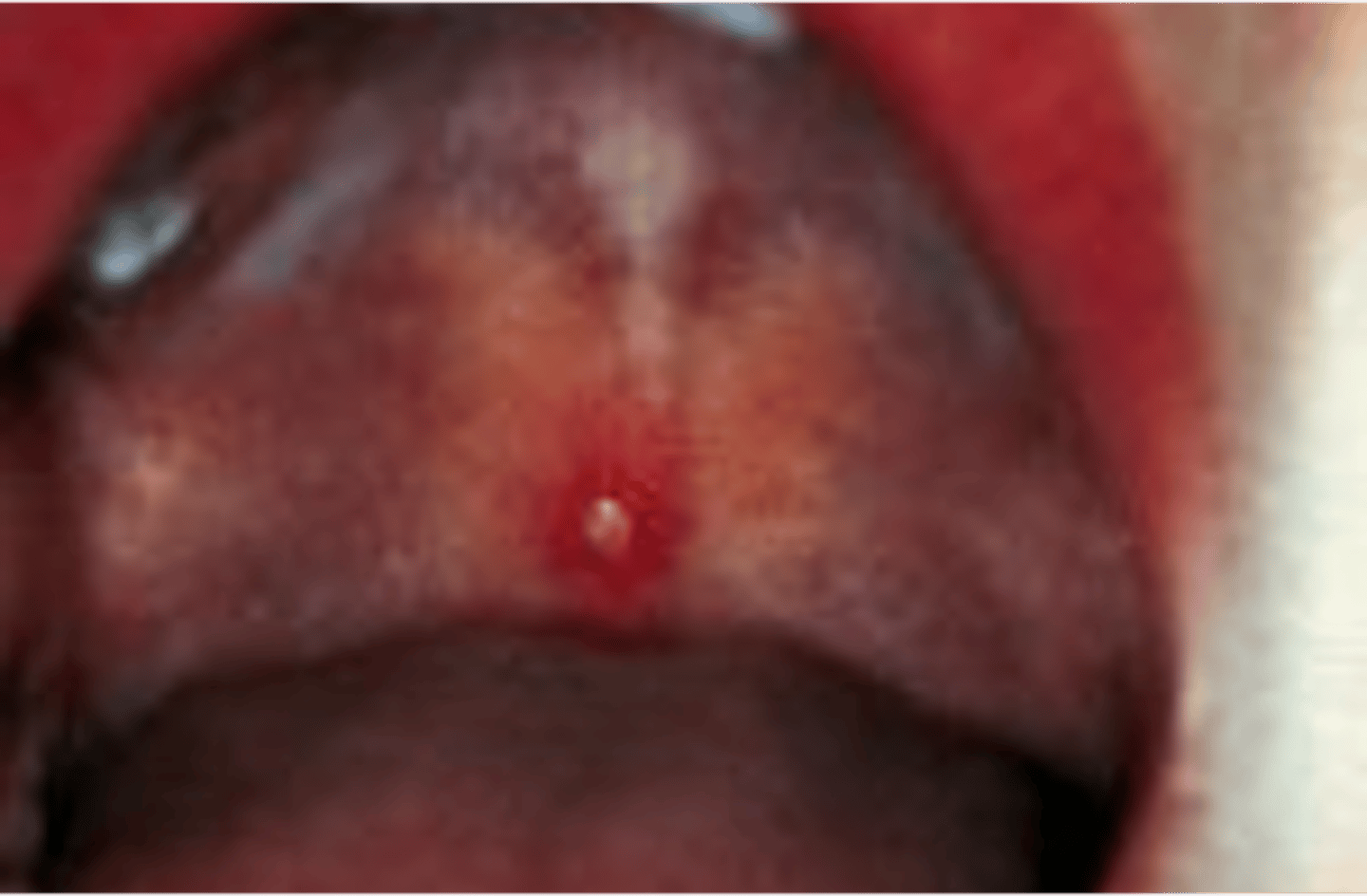 <p>___________________:</p><p>•Superficial skin cavity containing purulent exudate</p><p>•May be yellow, white, green-white, or hemorrhagic</p>
