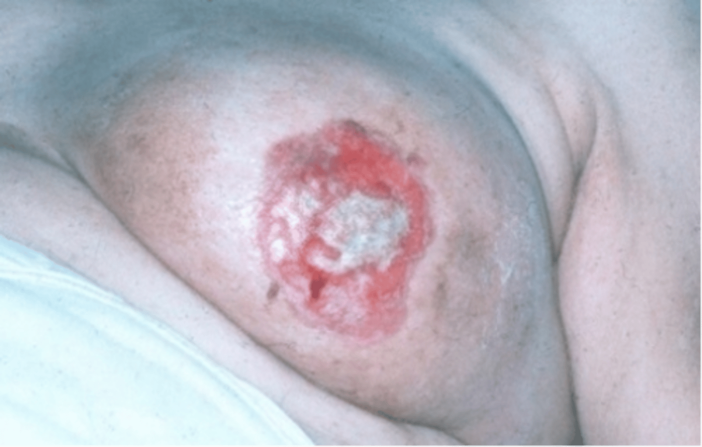 <p>uncommon form of breast cancer, starts as scaly eczema like lesion that may weep, crust, or erode</p>
