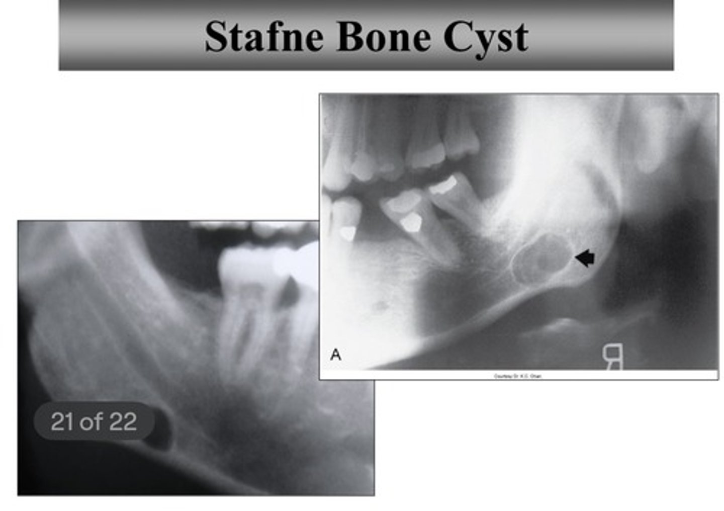<p>- cause: developmental concavity containing normal salivary tissue</p><p>- population: men (80-90% of the time)</p><p>- location: anterior to angle + inferior to mandibular canal (unilateral or bilateral)</p><p>- clinical features: asymptomatic</p><p>- radiographic features: well-defined cyst-like radiolucency</p>