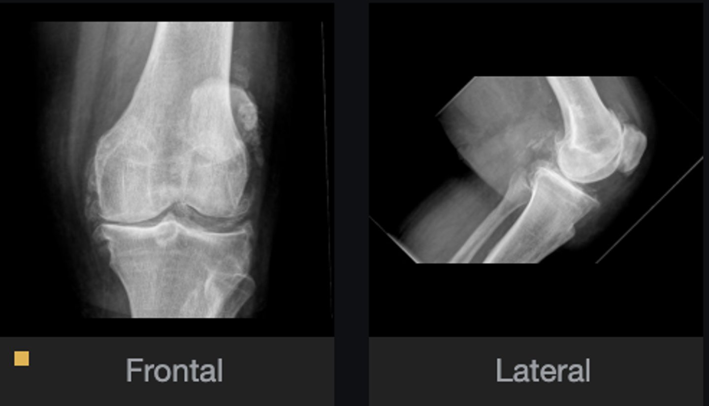 <p>Most likely diagnosis?</p>