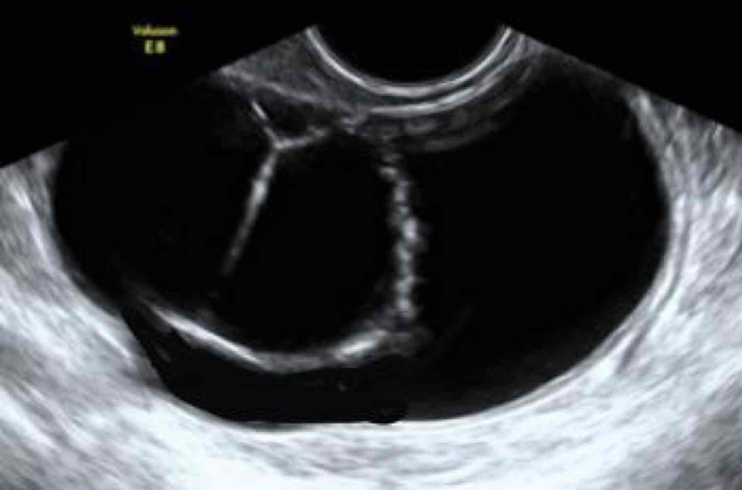 <p>(most common) 50-70% benign</p><p>simple septated thin walls</p><p>Age: 40-50 yo</p>