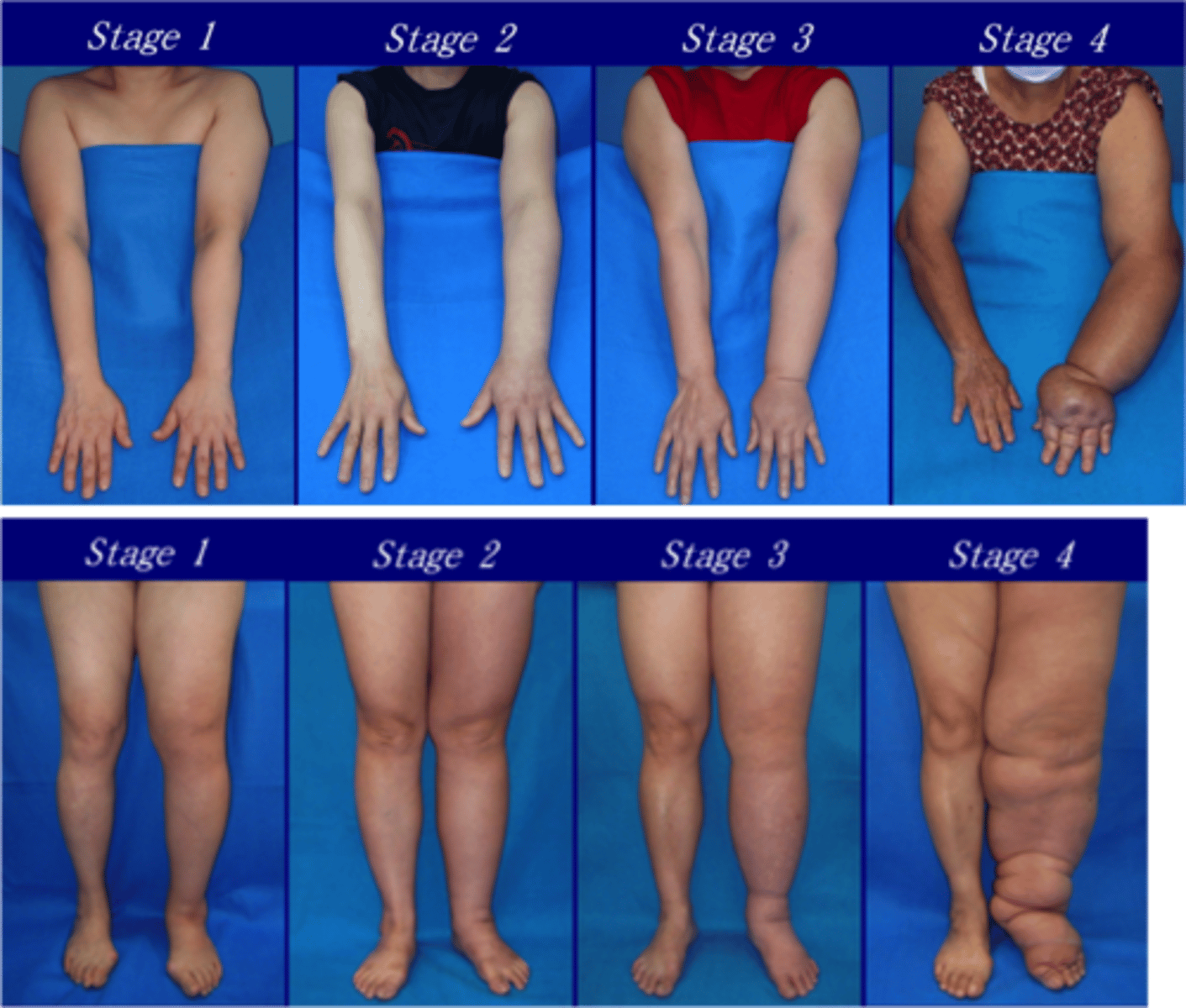 <p>spontaneously irreversible lymphedema; swelling with increase in fibrotic tissue; risk for infection</p>