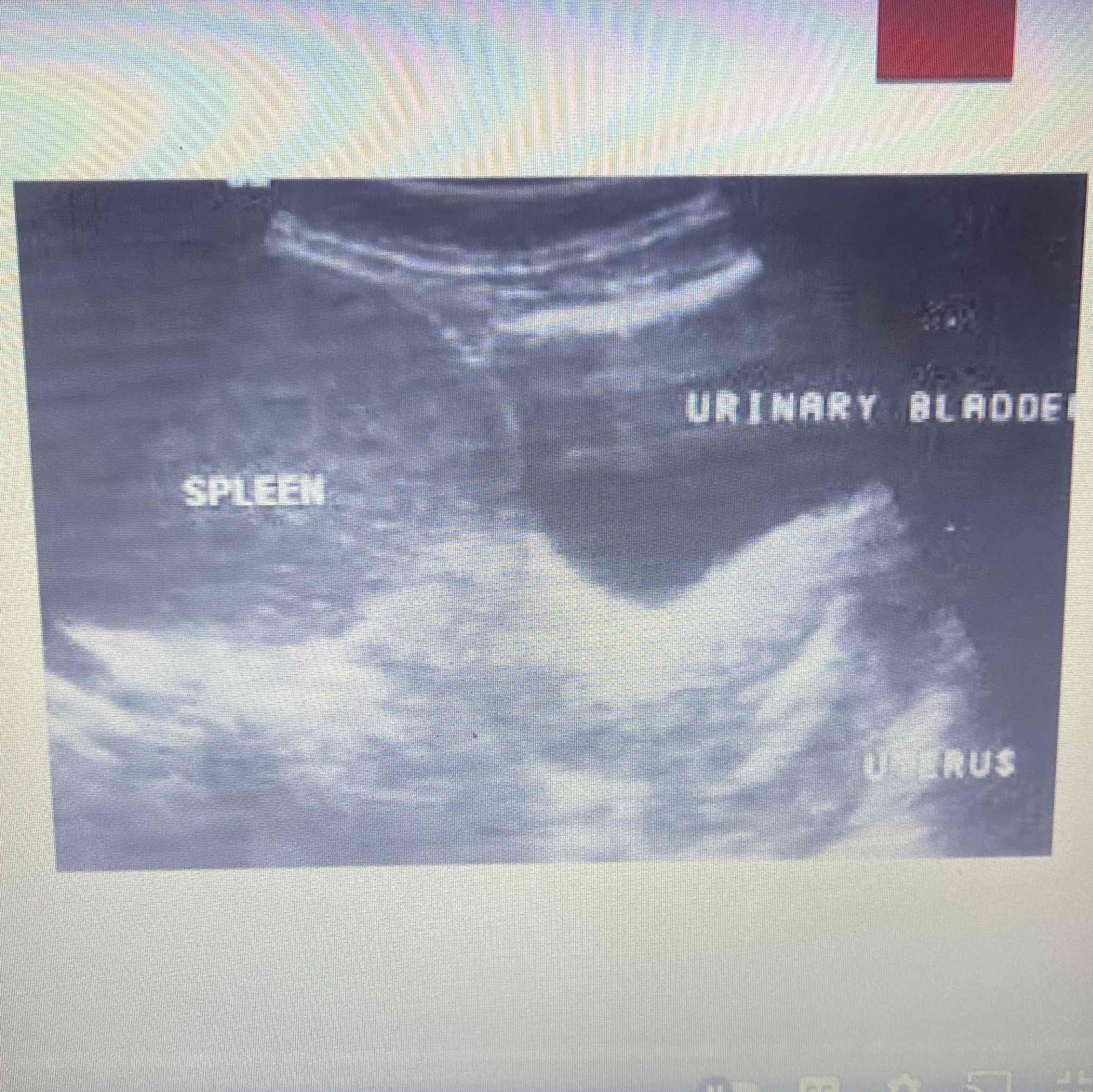 <ul><li><p>Abnormal migration during developmental stages of embryology</p></li><li><p>Positioned outside of normal LUQ location</p></li><li><p>Clinically; Asymptomatic, tenderness torsion is possible</p></li><li><p>Sonographic: Abdominal/pelvic mass, Decreased color, Doppler velocity in complete torsion.</p></li></ul>