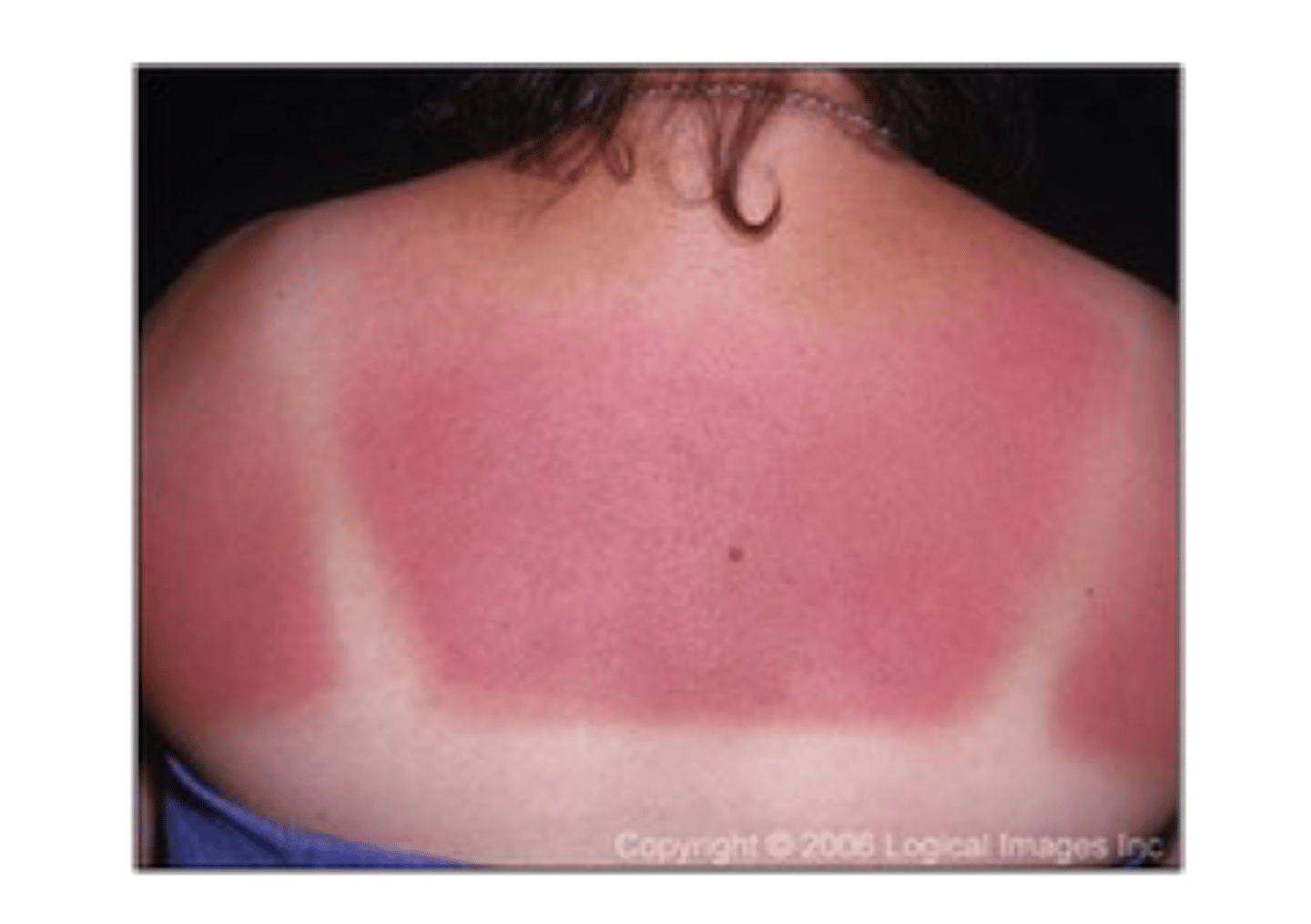 <p>sunburn</p>