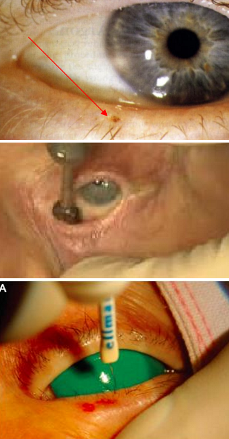 <p>This is the management of wha<strong>t </strong>eyelid condition:</p><ul><li><p><strong>Protect the ocular surface</strong></p><ul><li><p>Lubrication</p></li><li><p>Contact lenses</p></li><li><p><strong>Epilation </strong>- lash removal</p><ul><li><p>Forceps (every 6-10 weeks)</p></li><li><p>Argon Laser Photocoagulation</p></li><li><p>Cryotherapy (cold gas freezes lash follicles)</p></li><li><p>Radiofrequency ablation (ablates root of lash follicle)</p></li></ul></li></ul></li></ul><p></p>