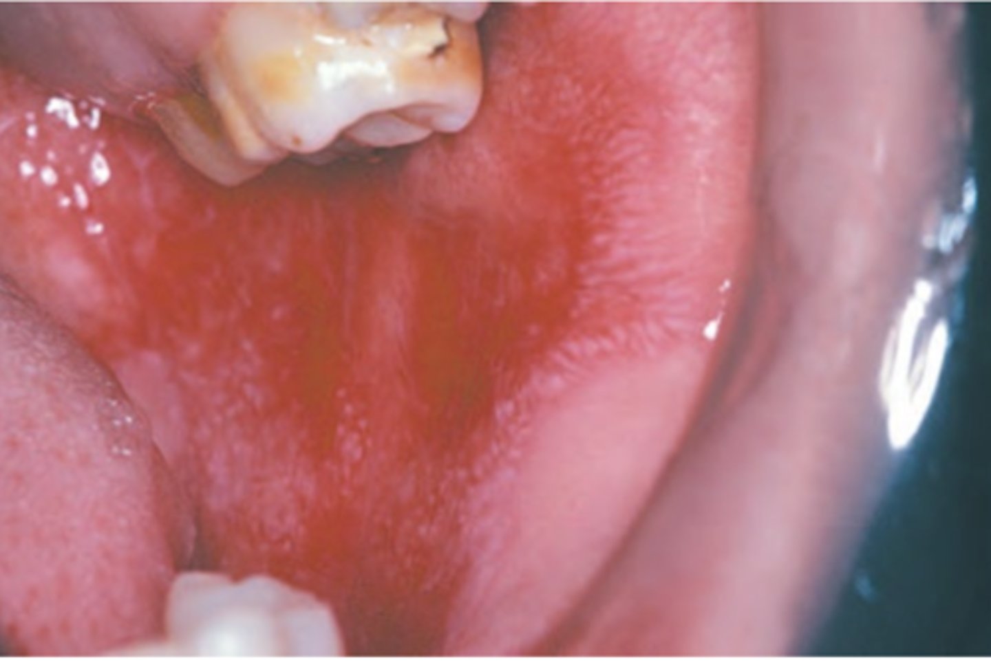 <p>Hint: Oral lesions identical to erosive lichen planus</p>