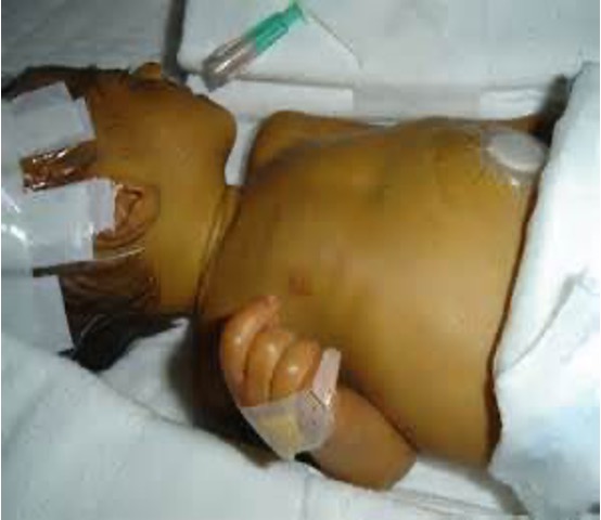 <p><strong>What occurs in 50% of newborns because their immature liver isn’t able to efficiently remove bilirubin?</strong></p>