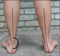 <p><span>This image shows calcaneal valgus or varus?</span></p>
