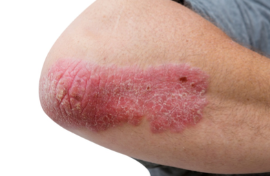 <p>Primary Skin Lesion</p><ul><li><p><strong>Raised lesion</strong> of <strong>more than 0.5 cm</strong></p></li><li><p>May <strong>coalesce</strong> or <strong>merge</strong></p></li><li><p>E.g., seborrheic keratosis</p></li></ul><p></p>