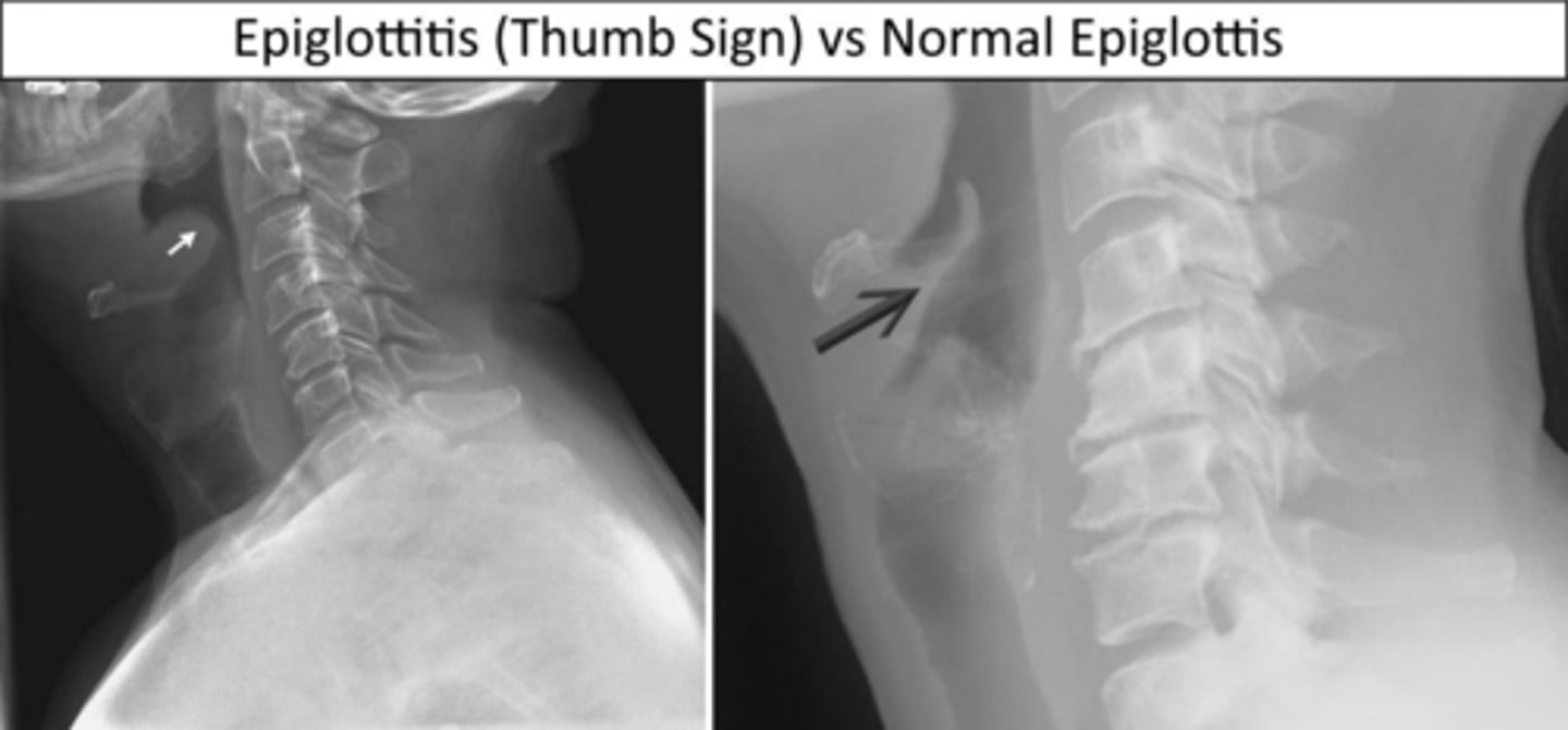 <p>The 'thumb sign' on a lateral neck X-ray, indicating a swollen epiglottis.</p>