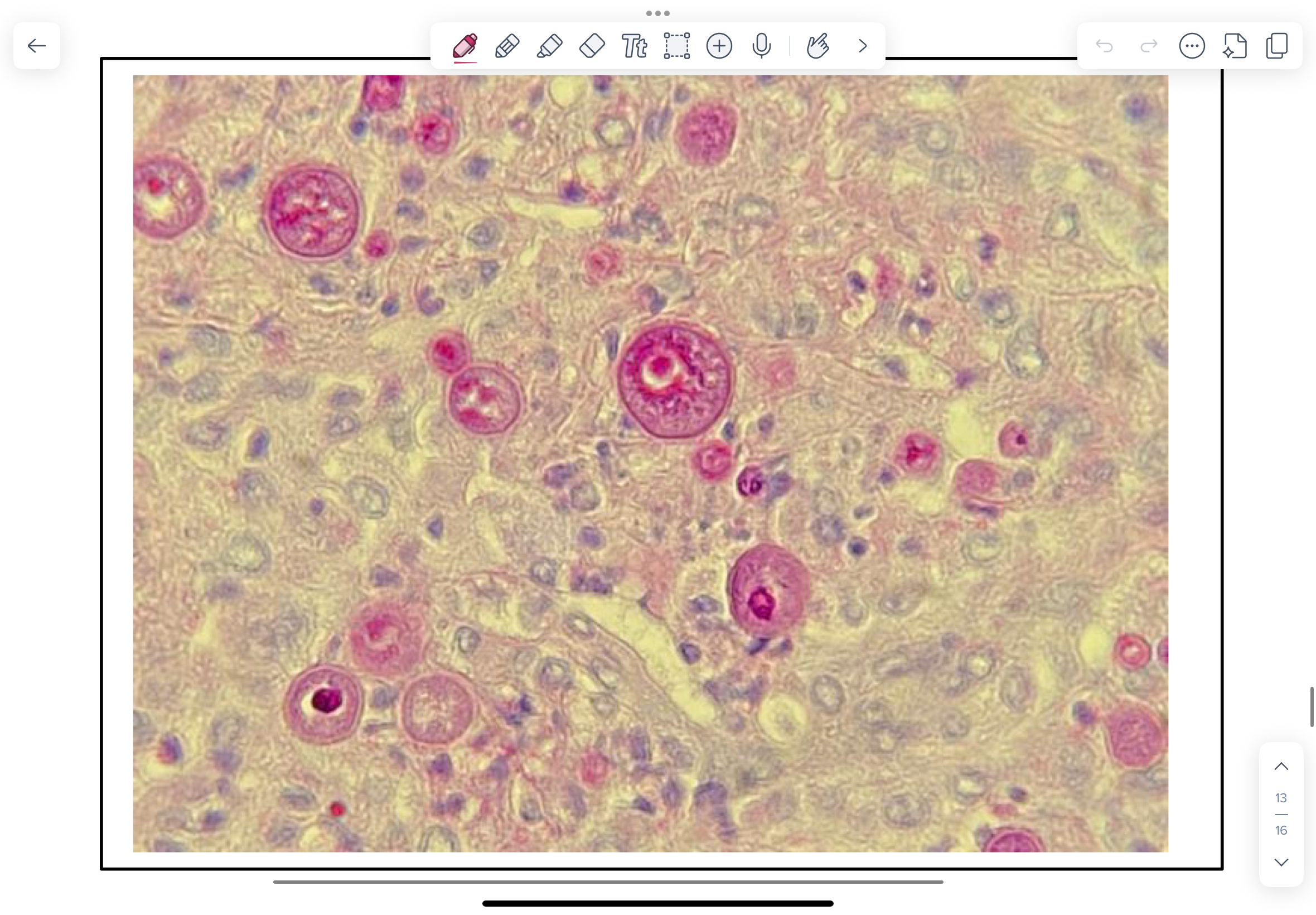 <p>North American dogs with coccidiodomycosis will have a history of travel to south western United States (Arizona, Utah, New Mexico, California) or Mexico where Coccidioides spp. are endemic.</p><p>PAS-stained histological lung preparation from a dog with coccidioidomycosis.</p><p>NOTE endosporangia (called spherules) varying from 20µm (immature) to 200µm (mature and filled with infectious endospores) in diameter and surrounded by inflammatory cells.</p>