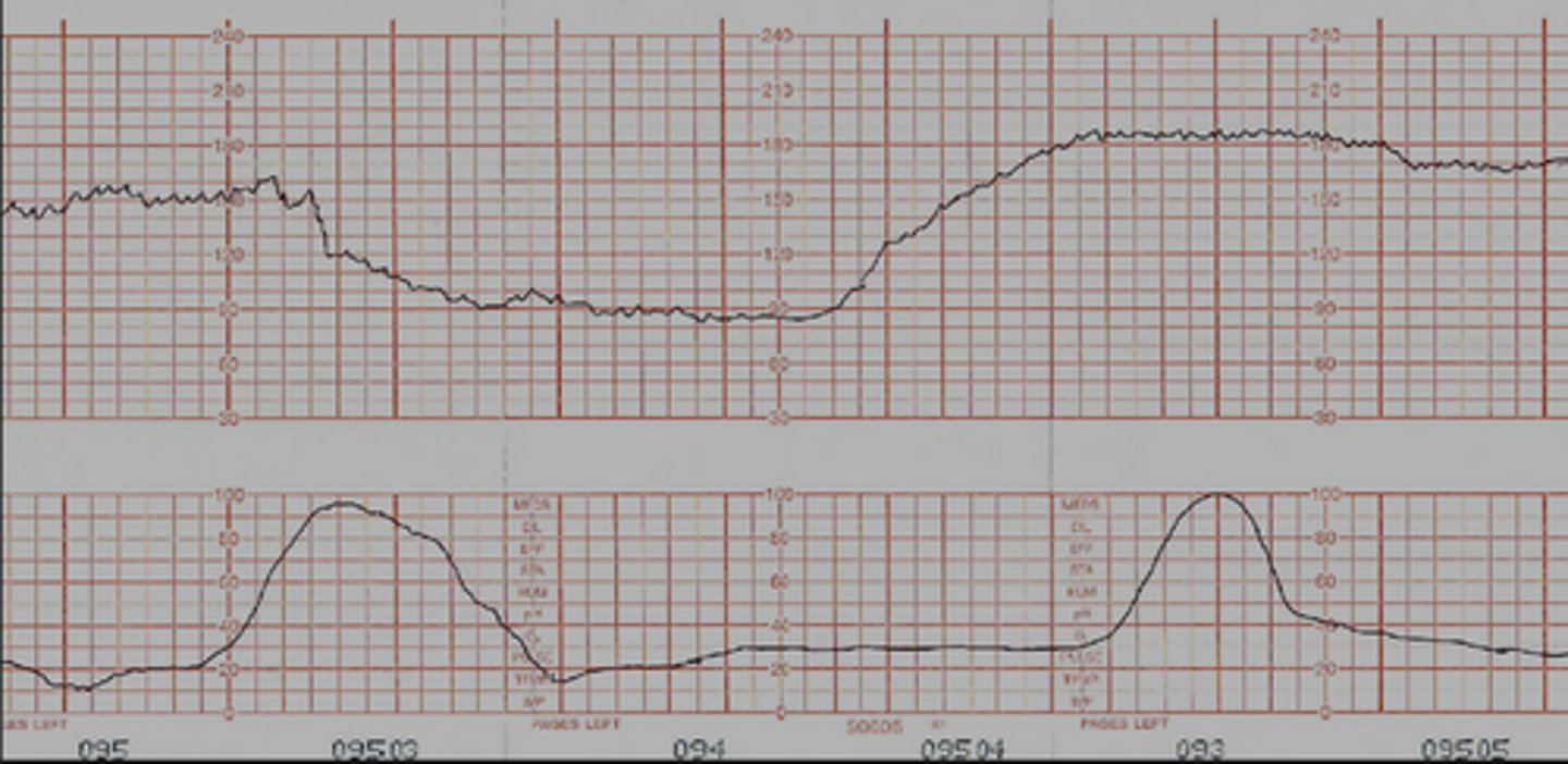 <p>Dips down and stays down with decreased variability</p><p>- After a few minutes of this, usually head to C-section</p>