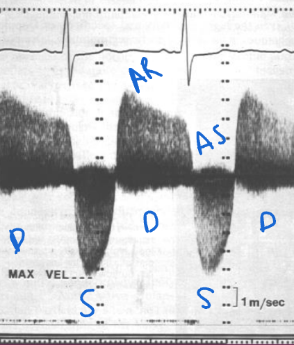 <p>Leaking in diastole. There is also stenosis here! Shown in systole with a velocity higher than 1 m/s. (@ 5 m/s) </p>