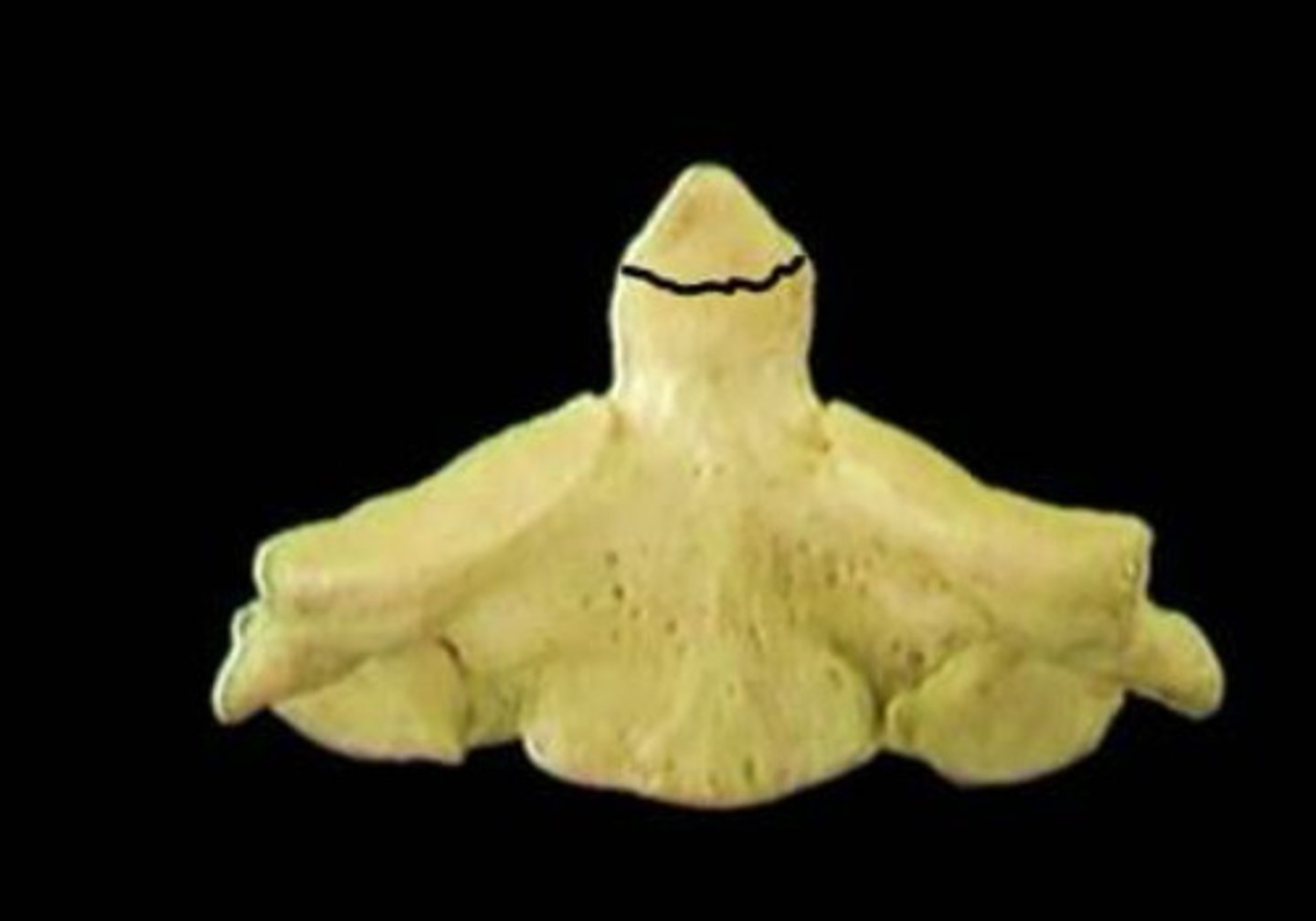 <p>What type of dens fracture is this?</p>