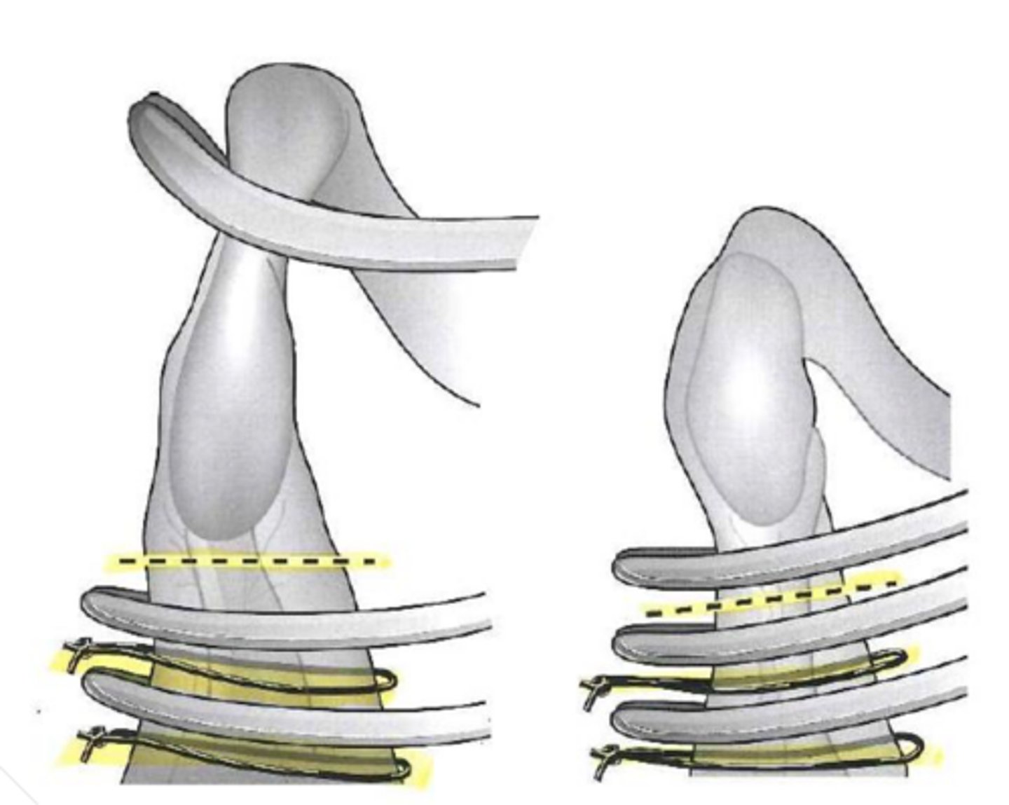 <p>what technique is shown on the right side and is the standard method that applied all three clamps on the same side of the ovary</p>