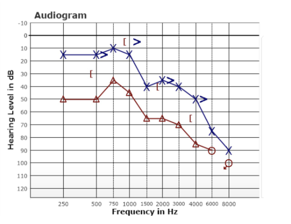 <p>How would you describe this audiogram?</p>